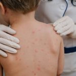 Statistic alarmant aproape jumtate dintre copii nu sunt vaccinai mpotriva rujeolei
