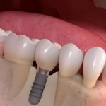 Cat dureaza un implant dentar si cum poti sa ii prelungesti viata