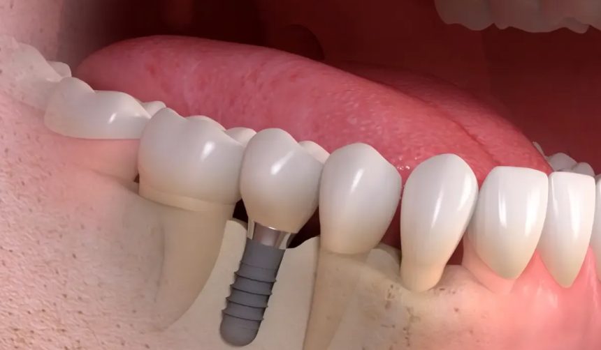 Cat dureaza un implant dentar si cum poti sa ii prelungesti viata