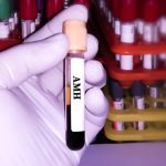 Functia AMH in evaluarea rezervei ovariene